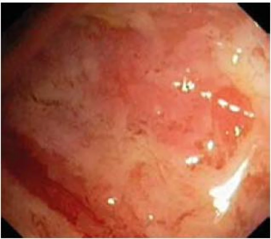 Aktivní fáze ulcerózní kolitidy se spontánním krvácením a plošnými ulceracemi (Mayo skóre 3).
Fig. 1. Acute phase of ulcerative colitis with spontaneous bleeding and superficial ulcerations (Mayo score 3).