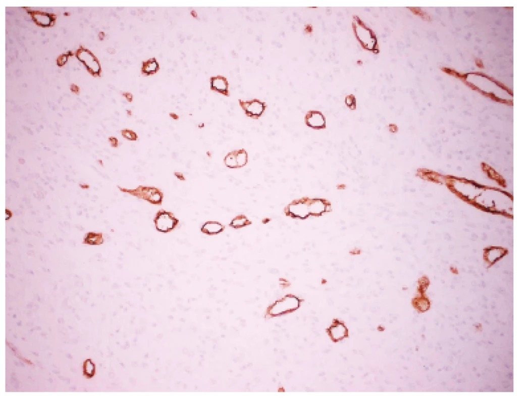 Imunohistochemický dokaz CD31 v endoteli ciev. Nádorove bunky sú negatívne. Zvačšenie 200x.