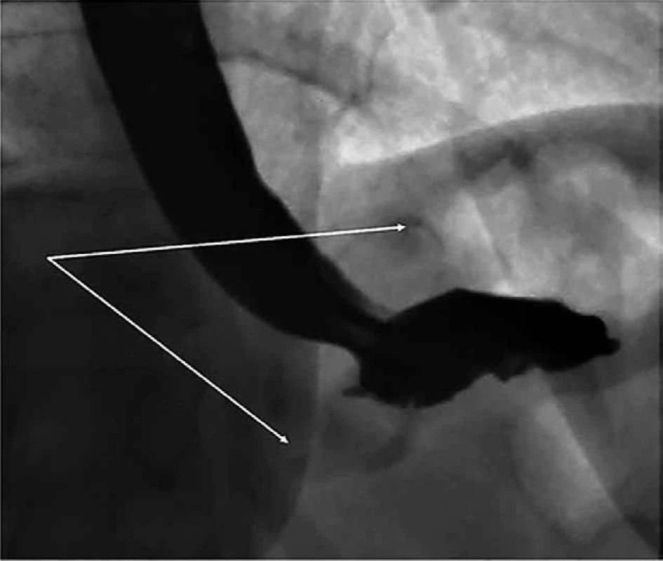 Sklouznutí AGB na abdominální jícen    Fig. 1: Slippage of AGB on to abdominal oesophagus