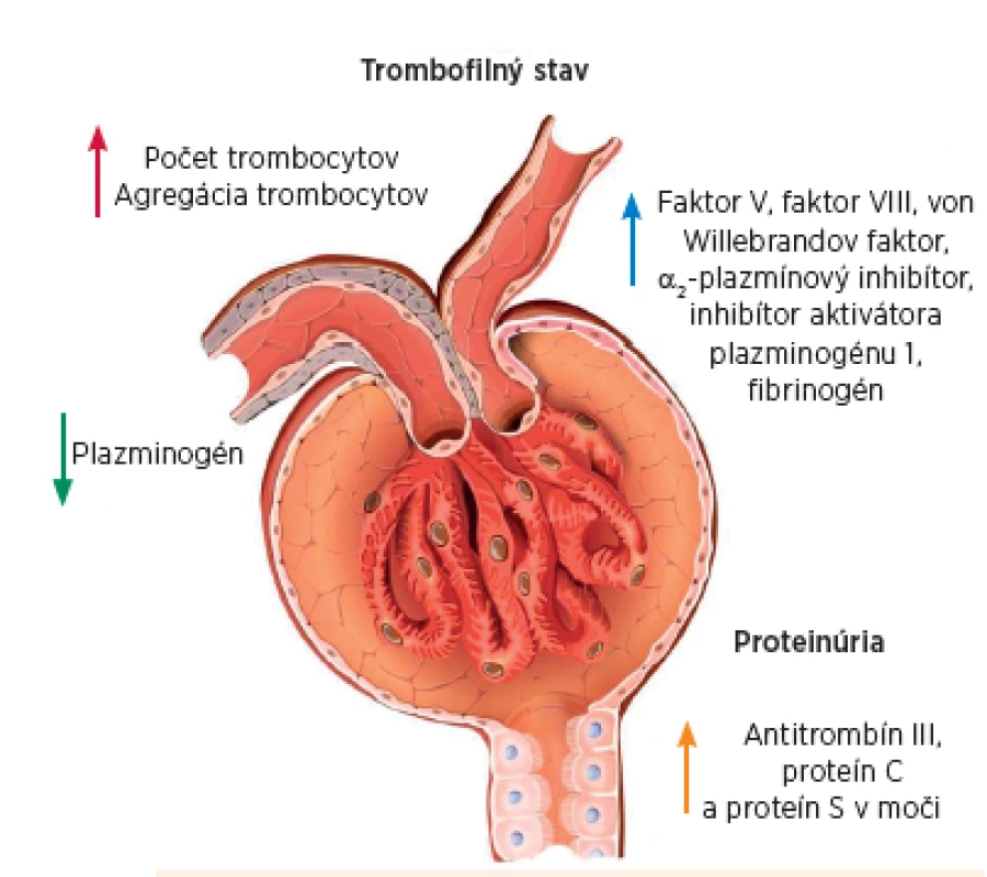 Mechanizmy trombofilného stavu pri nefrotickom syndróme.
Fig. 4. Mechanisms of the thrombophilic state in the nephrotic syndrome.