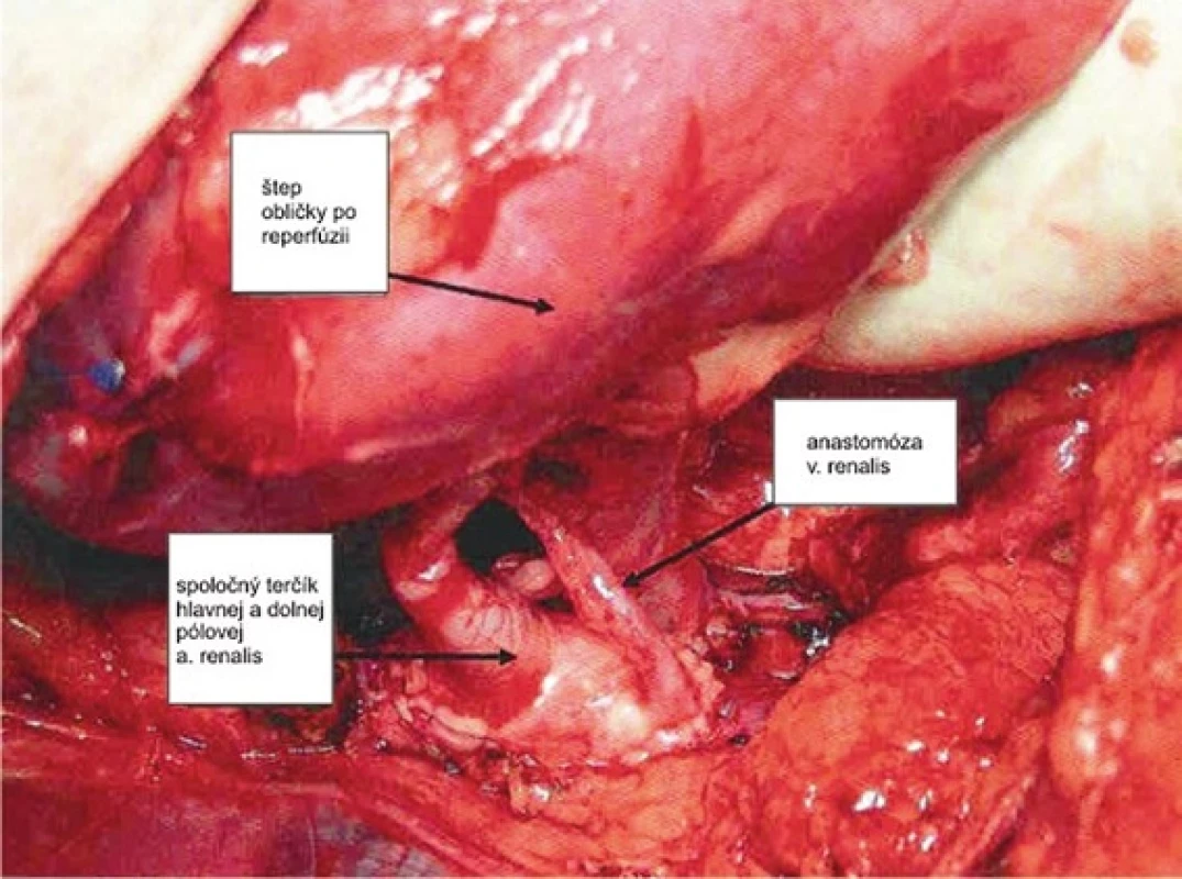 Našitie graftu arteriálna a venózna anastomóza
(I. Chirurgická klinika UNLP, Košice)
Fig. 7 : Graft reperfusion renal - artery and venous anastomosis
(I. Clinic of Surgery University Hospital, Košice)