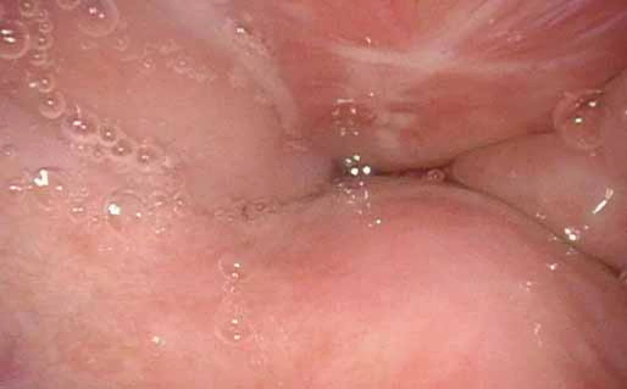 DISE – koncentrický uzávěr v oblasti velofaryngeální úžiny.
Fig. 2. DISE – concentric closure of velopharyngeal strait.
