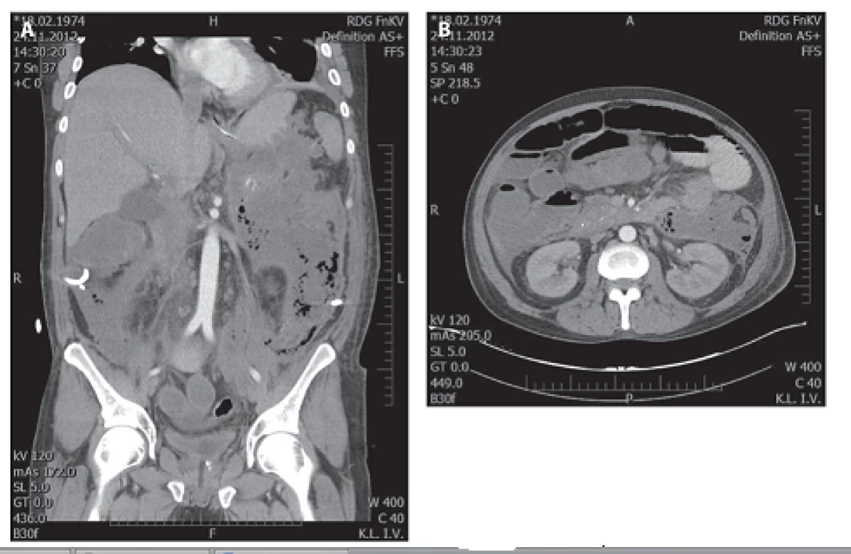 a, 2b: Masivní kolekce tekutiny a nekrotické tkáně s bublinkami plynu v retroperitoneu
Fig. 2a, 2b: Massive fluid collection and necrotic tissue with gas bubbles in retroperitoneum