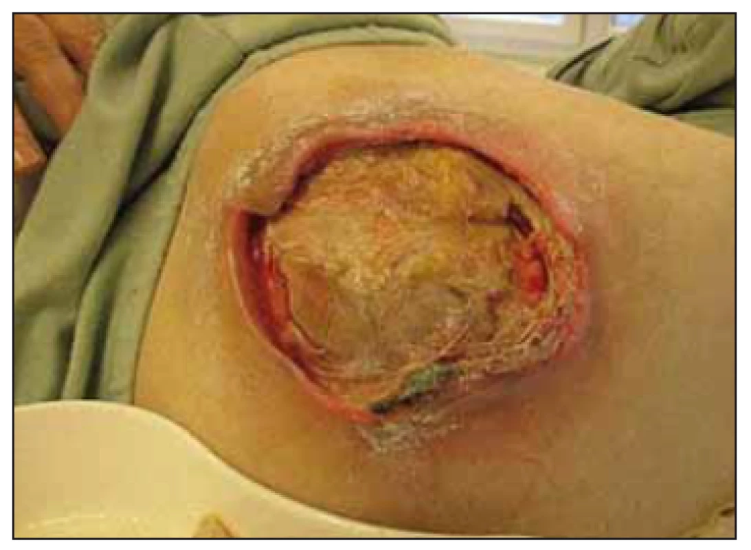 Case study B – the trochanteric
pres sure ulcer – National Pressure Ulcer
Advisory Panel (NPUAP) IV. category.<br>
Obr. 4. Klinický prípad B – dekubitus
v oblasti trochantera, IV. stupeň podľa
National Pressure Ulcer Advisory Panel
(NPUAP).