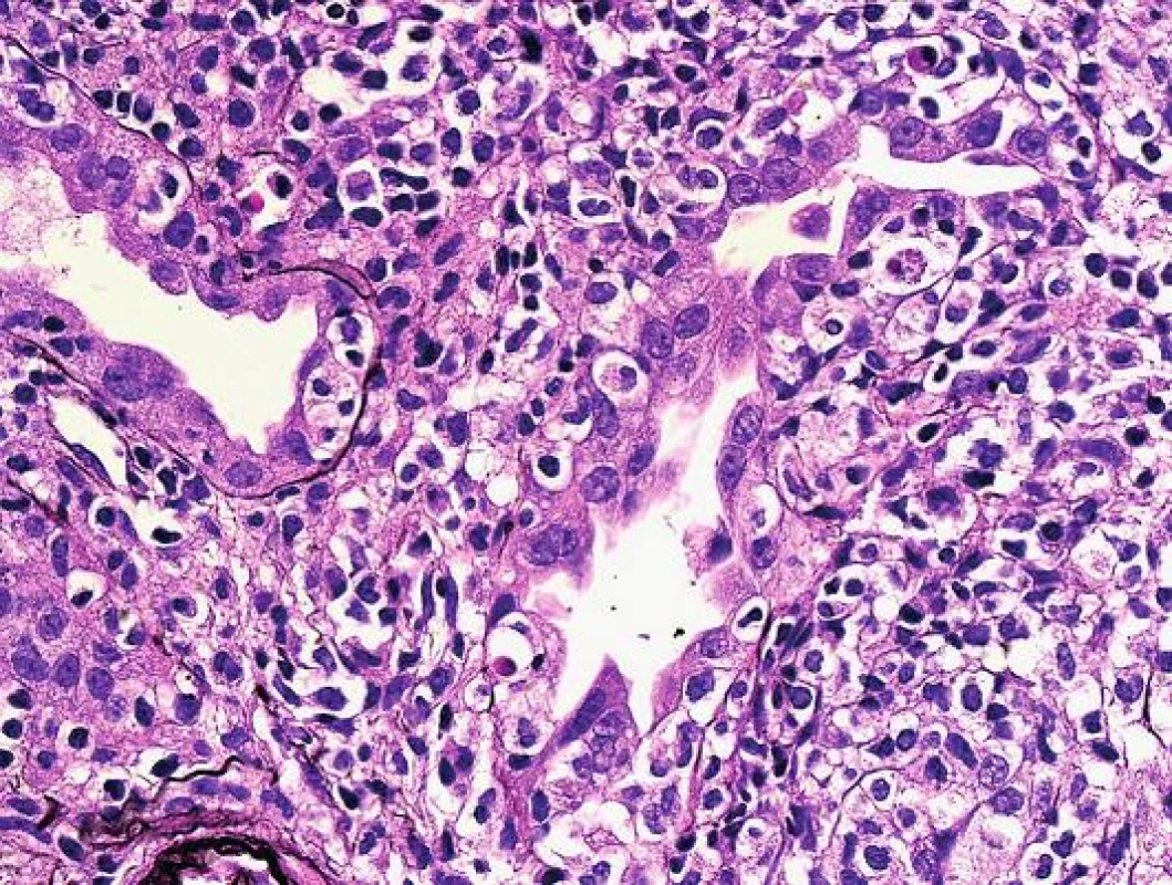 Detail těžkého poškození tubulů při tubulo-intersticiální rejekci s pestrou zánětlivou celulizací. Dobře rozpoznatelné halo v okolí intraepiteliálních lymfocytů a téměř cirkulární/kompletní destrukce tubulární bazální membrány (PAS, objektiv 40x).