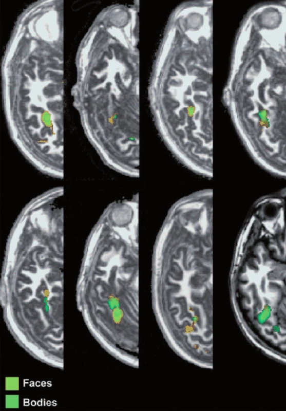 Extrastriátová oblast pro tělo (EBA, extrastriatal body area) v gyrus fusiformis selektivně zpracovává tvary lidského těla bez tváře (17).
Legenda:
Oranžová barva: tváře vs. nástroje.
Zelená barva: těla vs. nástroje.
Faces – tváře
Bodies – těla
