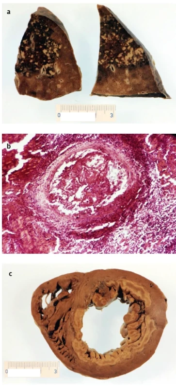 Pitevní nález u eozinofilní granulomatózy s polyangiitidou: a – dvě lamely z plic s vícečetnými uzly, b – intramyokardiální tepna s nekrózou, zánětlivou celulizací stěny eozinofily a s trombózou lumina, c – příčný řez přes srdeční komory: v levé komoře je cirkulární infarkt myokardu (světlejší barva) ve vnitřní polovině stěny; komora je dilatovaná