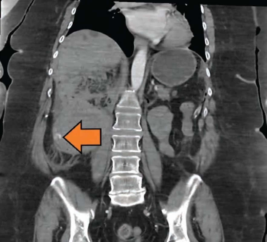 Prokázaný leak při CT angiografii. Fig. 3. Proven leak on CT angiography.