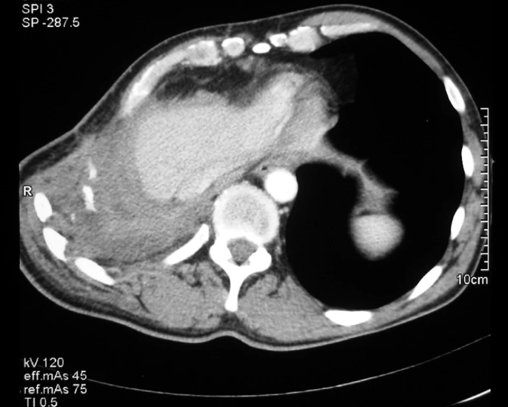 CT obraz dokumentuje vyplnenie zbytkovej dutiny omentom
Fig. 3. A CT view documents filling of the residual cavity with the omentum