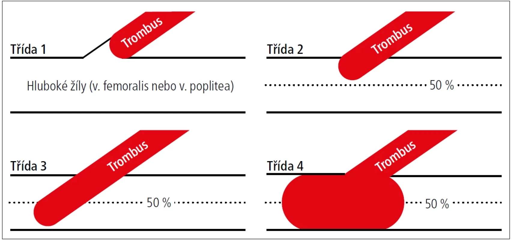 Ablation related thrombus extension (ARTE, dříve EHIT).