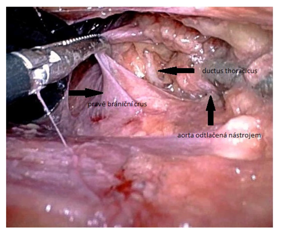 Identifikace ductus thoracicus u laparoskopického
přístupu v bráničním hiátu<br>
Fig. 4. Identification of the thoracic duct using laparoscopic
approach in the diaphragmatic hiatus