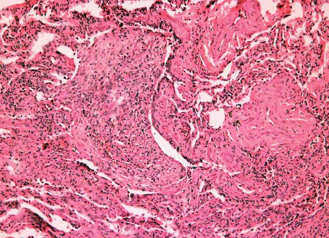 Chronická rejekce, grade C1, bronchiolitis obliterans (HE, x 400).