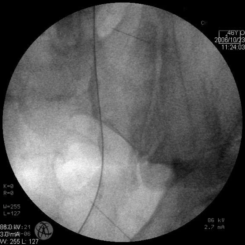 Ureterální striktura 12 cm
