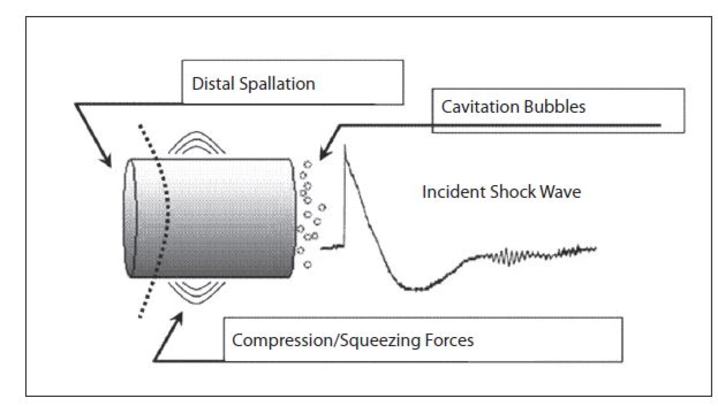 Jednotlivé mechanismy dezintegrace konkrementu při ESWL. Kavitace se nejvíce uplatňuje na proximální straně litiázy. (převzato ze Smith AD, Badlani GH, et al. Smith’s Textbook of Endourology, 2<sup>nd</sup> ed. Ontario, Canada: BC Decker Publishing 2006)
Fig. 3. Mechanism of a stone desintegration by ESWL. Kavitation is mostly used at the front area of lithiasis.