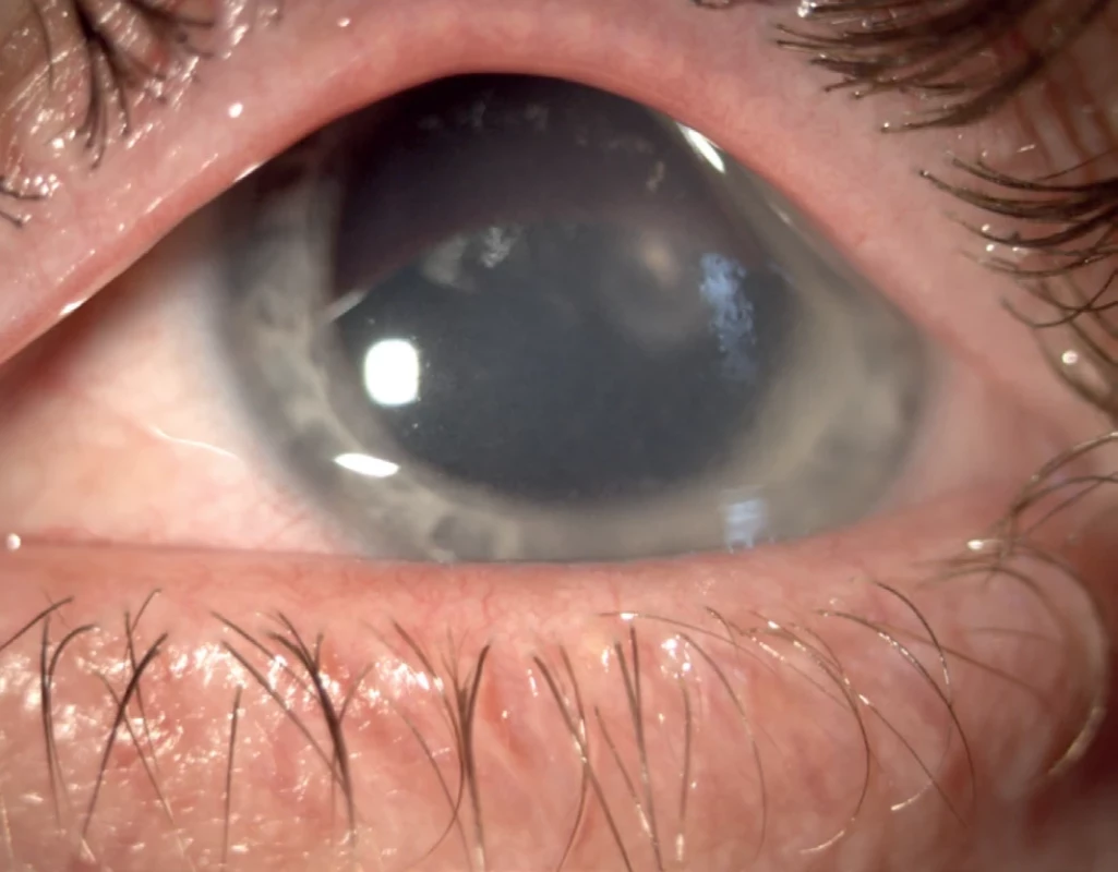 Image of the anterior segment of the left eye in the case report patient after initiation of antiviral treatment