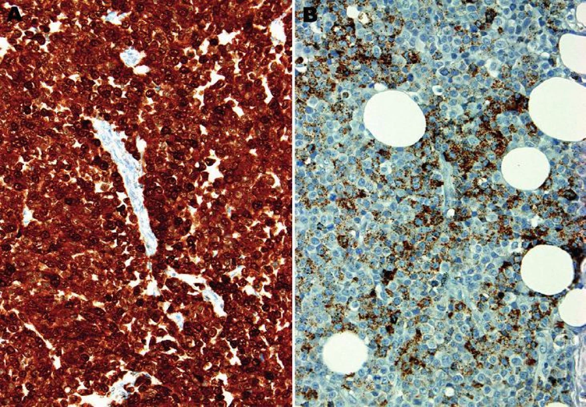 A: Difúzní silná jaderná i cytoplazmatická pozitivita S100 proteinu. B: Ložisková, jemně granulární cytoplazmatická pozitivita antigenu HMB45 (imunohistochemie, 200x).