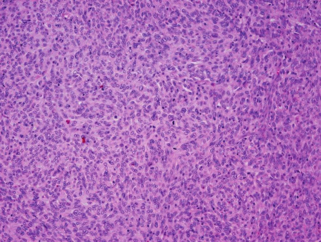 Recidiva tumoru − barvení hematoxylin eosin recidivy tumoru s patrnou výraznou polymorfií jader i buněk s četnými mitózami
Fig. 8: Tumor recurrence − hematoxylin and eosin staining of tumor recurrence with considerable polymorphism of the nuclei and cells with numerous mitoses