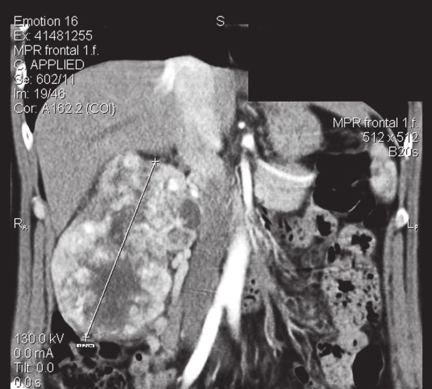 Tumor pravé ledviny
Fig. 1. The tumor of the right kidney