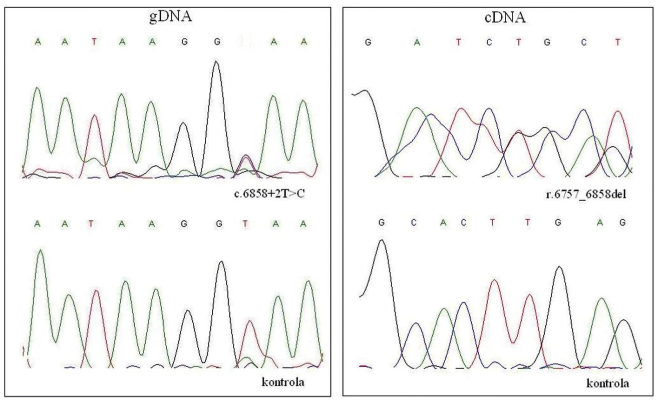 DNA analýza NF1 genu. 