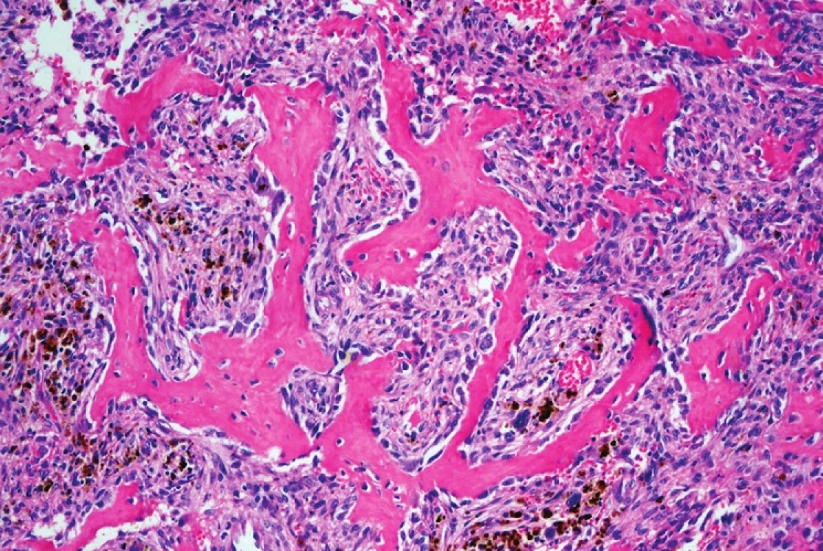 V sousedství hnědých nádorů je možno identifikovat charakteristické znaky fibrózní osteodystrofie. Na povrchu kostních trámců jsou četné osteoklasty a dřeňové prostory jsou fibrotizovány. HE, x100.