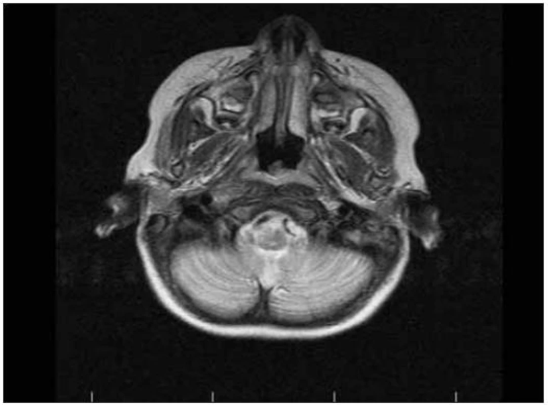 MRI po výkonu.
