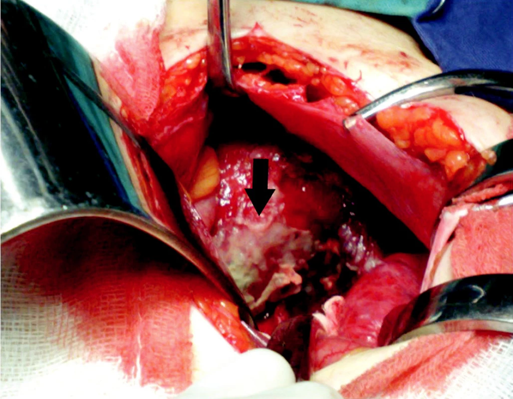 Peroperačný pohľad – zvyšky hnisavých pablán na povrchu maternice (čierna šípka)
Pic. 2. Peroperative view – residue purulent coat on the surface of uterus (black arrow)
