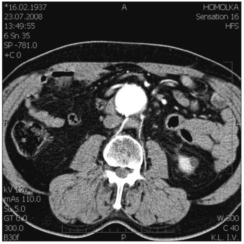 Verifikace průchodných větví na předoperační CT AG: na zadním obvodu aa. lumbales, na předním obvodu a. renalis accessoria
Fig. 2. Verification of patent branches on preoperative CT AG: posterior circumference of aa. lumbales, anterior circumference of a. renalis accessoria