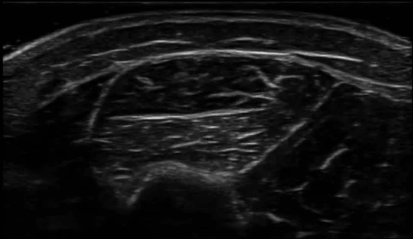 Zobrazení hluboké fascie při použití dostatečné vrstvy sonogelu, konkrétně v lokalitě lateral na bérci. Fig. 2. Demonstration of the use of a sufficient layer of ultrasound gel to visualize the deep fascia on the lateral side of the lower leg, specifically at the lateral location.