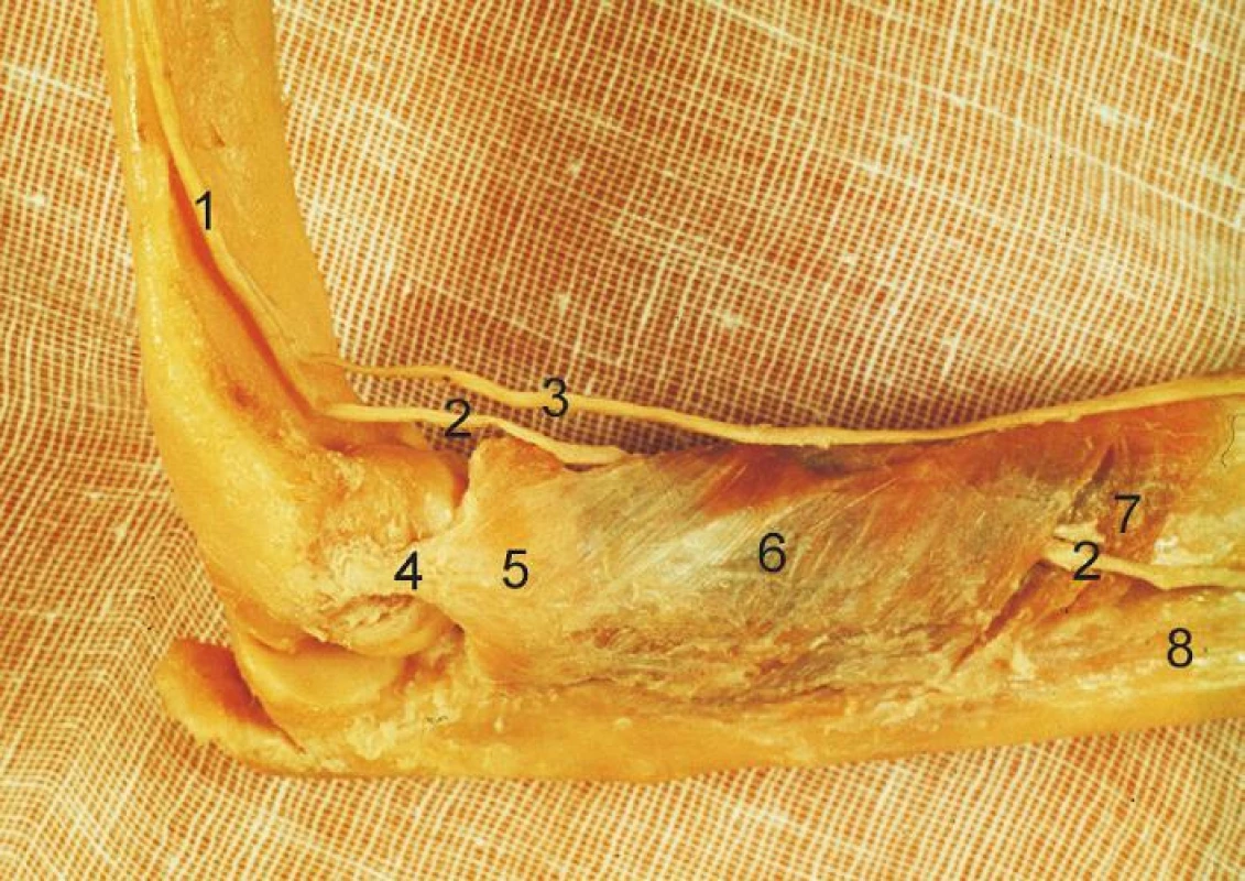 Komplex lig. collaterale lat. a m. supinator: 1 – n. radialis, 2 – r. profundus n. radialis, 3 – r. superficialis n. radialis, 4 – lig. collaterale lat., 5 – lig. anulare radii, 6 – povrchová vrstva m. supinator, 7 – hluboká vrstva m. supinator, 8 – ulna. <i>(Převzato z Bartoníček J, Heřt J. Základy klinické anatomie pohybového aparátu. Praha, Maxdorf 2004.)</i>
Fig. 4: Lateral collateral ligament complex and the supinator: 1 – radial nerve, 2 – deep branch of radial nerve, 3 – superficial branch of radial nerve, 4 – lateral collateral ligament, 5 – radial annular ligament, 6 – superficial layer of the supinator, 7 – deep layer of the supinator, 8 – ulna.<i>(Reprinted from Bartoníček J, Heřt J. [Outline of Clinical Anatomy of Musculoskeletal Apparatus]. Praha, Maxdorf 2004.)</i>