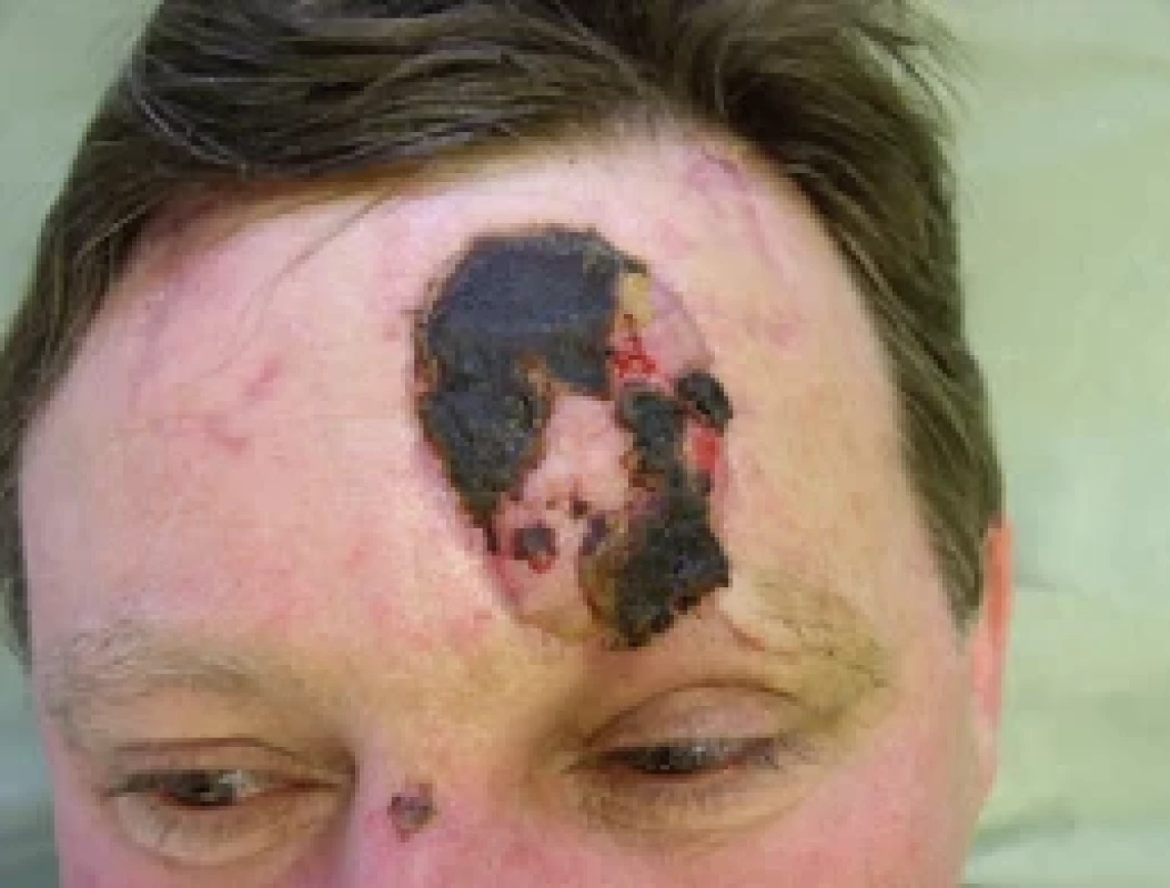 Flap necrosis 2 weeks after fl ap ischemia. Source: archive of authors.