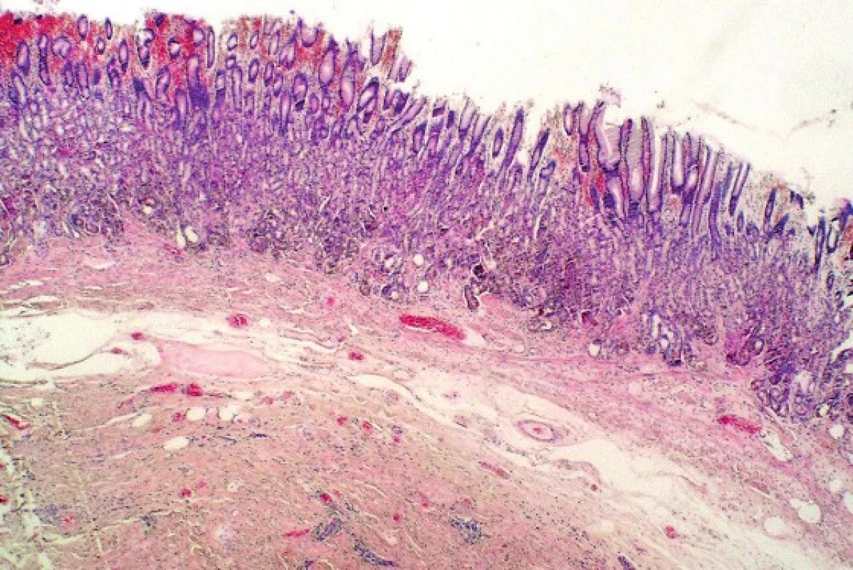 Low power view of a well-circumscribed tumor located beneath intact gastric mucosa (HE, 40x).