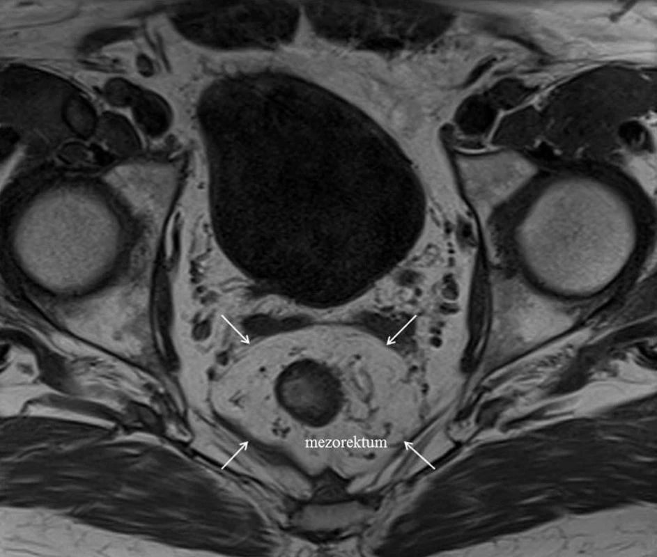 T1-vážený axiálny MRI scan tumorom rekta s vyznačením fascia recti propria (biele šípky), ktorá predstavuje potenciálny chirurgický CRM
Fig. 3: T1-weighted axial MRI through rectal tumour showing the fascia propria recti (white arrows), which presents potential surgical CRM