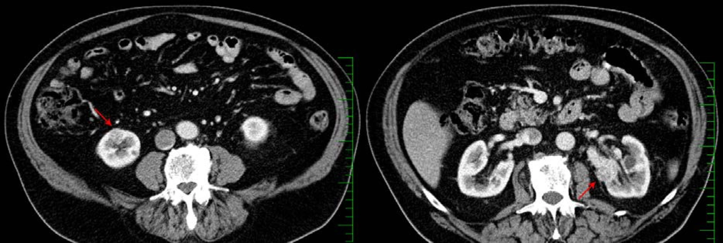 CT, transverzální řez, arteriální fáze: bilaterální světlobuněčný renální karcinom pT1a (červené šipky)
Fig. 3. CT scan, axial section, arterial phase: bilateral clear cell renal cell carcinoma pT1a (red arrows)