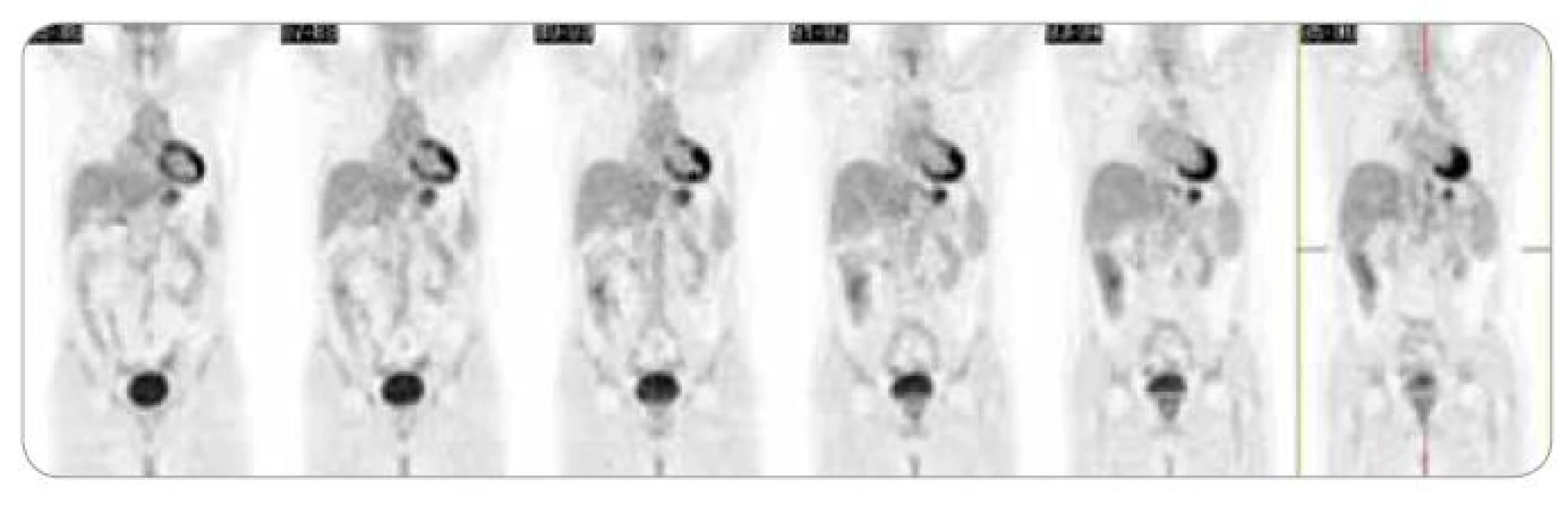 PET + CT červenec 2009.