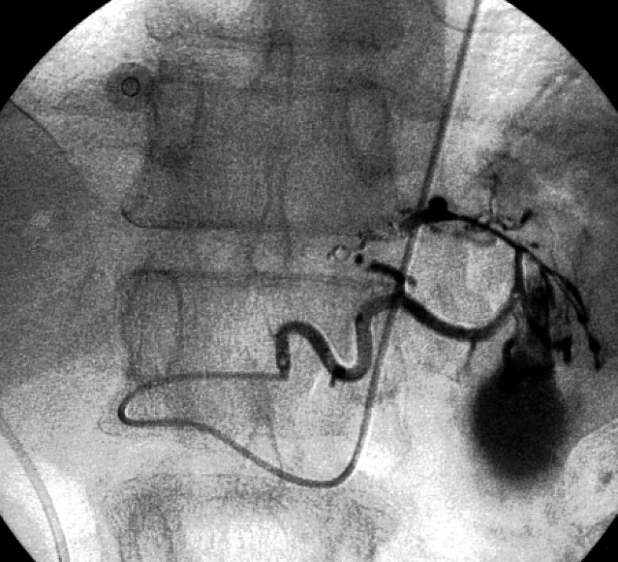 Selektivní angiografie pravé gastrické tepny zobrazuje opacifikující se pseudoaneuryzma.