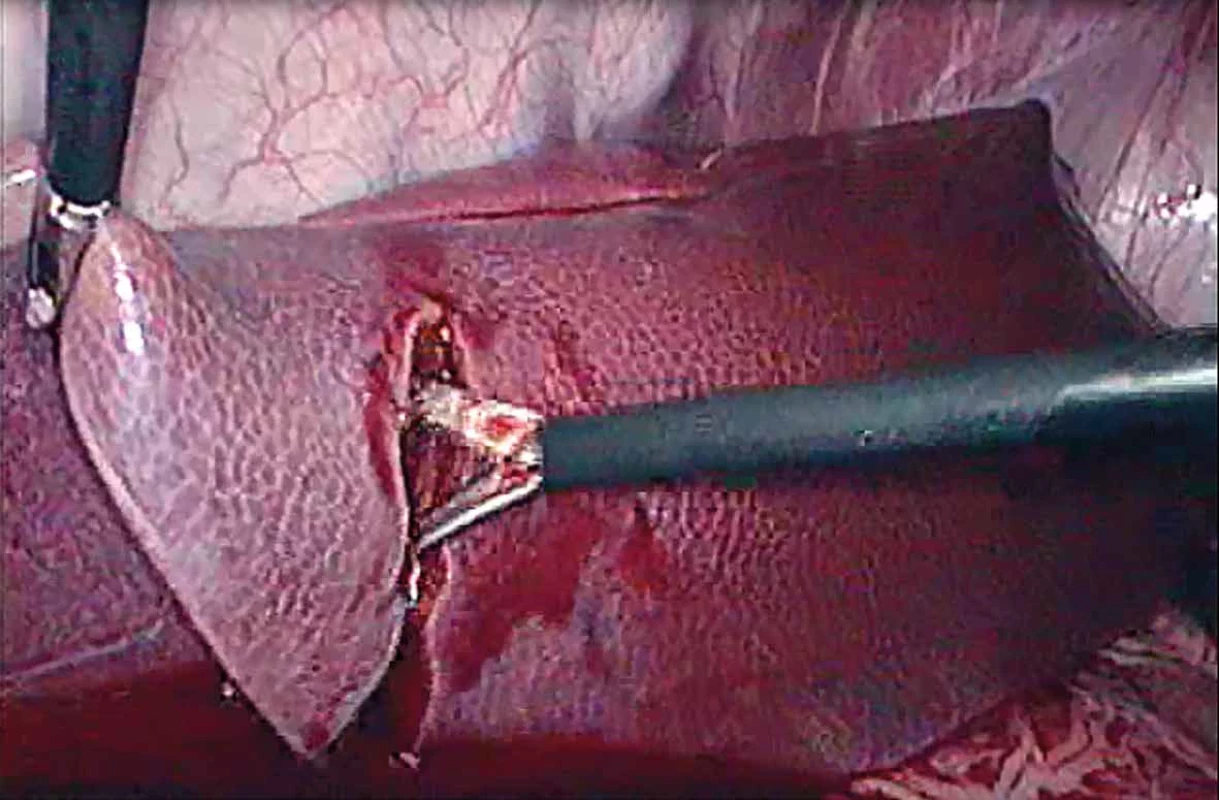 Model poranění jater   Fig. 2: Liver injury model