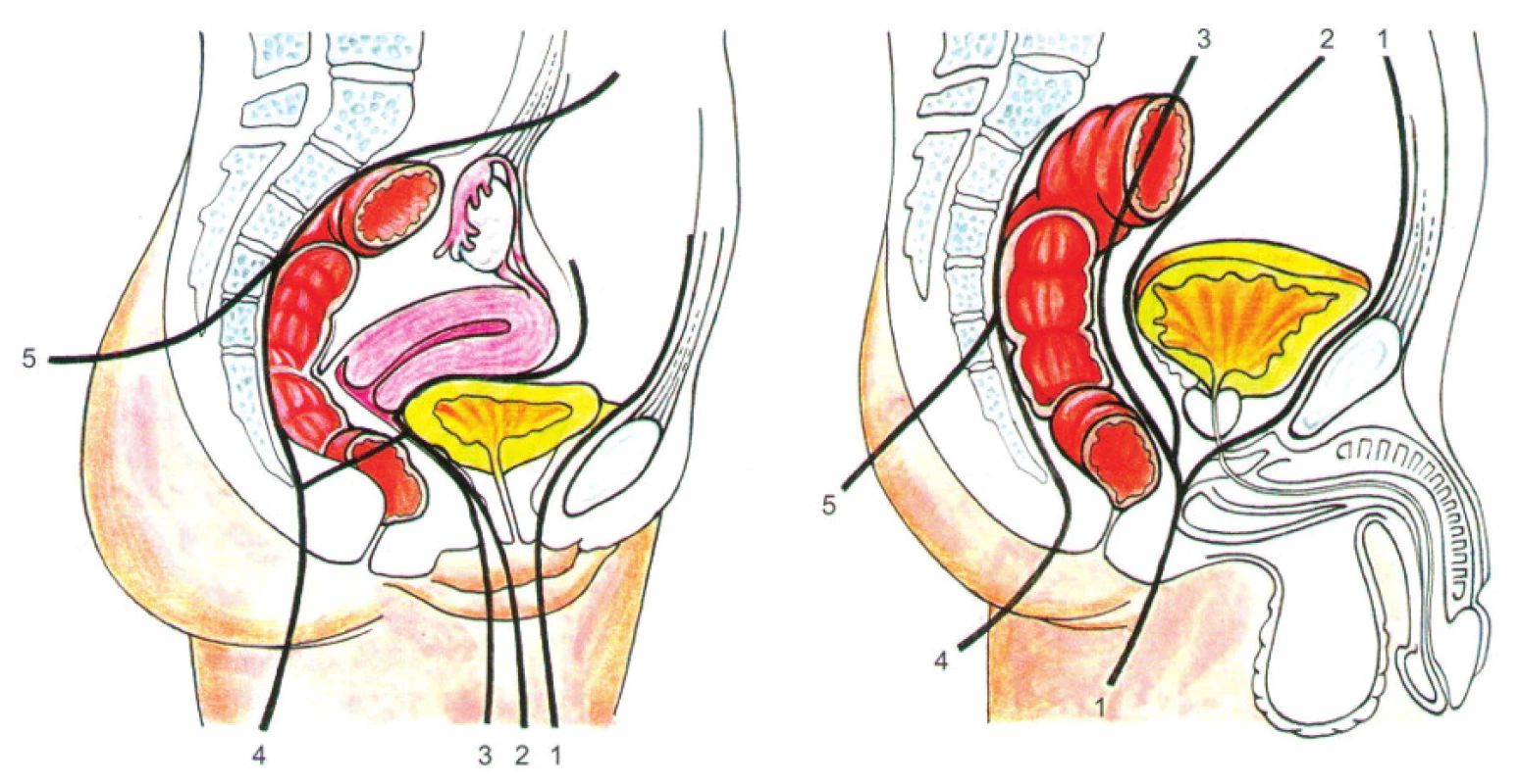 Klasifikace jednotlivých typů pánevních exenterací: přední 1–3, zadní 2–4, totální 1–4, totální kompozitní 1–5 [5]
Fig. 1: Types and classification of pelvic exenterations: anterior 1–3, posterior 2–4, total 1–4, total composite 1–5 [5]