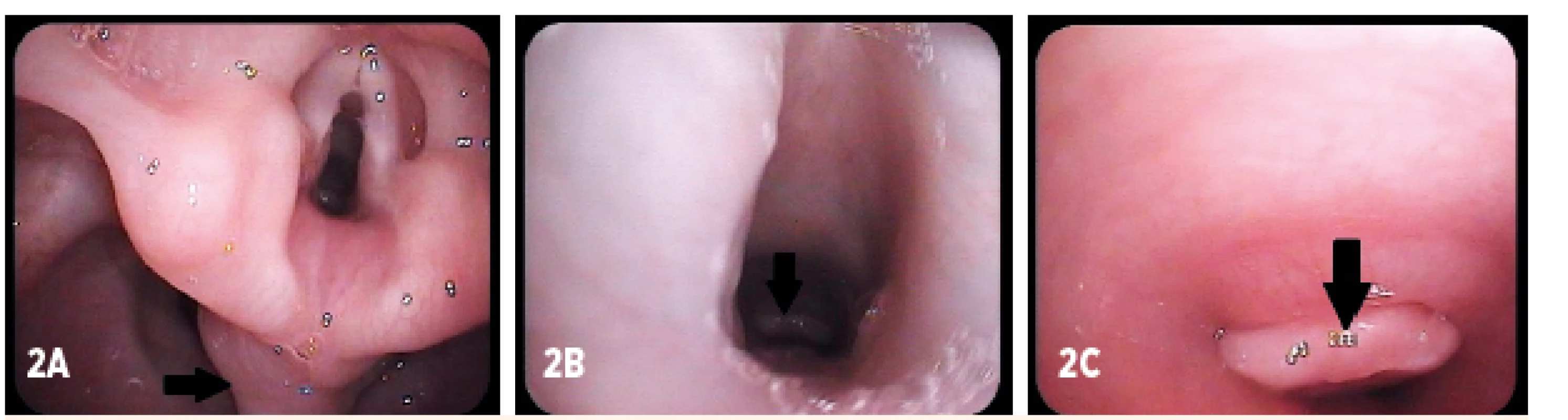 Kontrolná fibroskópia (vek dieťaťa 17 mesiacov). A – prolaps sliznice postkrikoidnej oblasti (šípka), B, C – granulácia v oblasti tracheostómie (šípka)
Fig. 2. Control fibroendoscopy (age of child 17 months). A – mucosal prolaps in the postcricoid area (arrow), B, C – granulation above the tracheostomy (arrow)