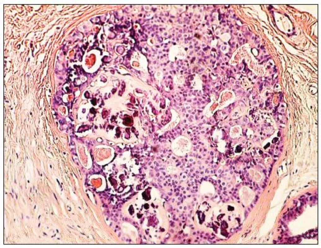 DCIS s mikrokalcifikacemi
Fig. 1. DCIS with microcalcification