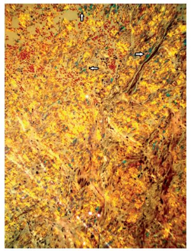 Zelený dichroismus v polarizačním světle – typický pro amyloid (barvení Kongo červeň, zvětšení 200×)
Fig. 3. Green birefringence under cross-polarized light – typical of the amyloid (Congo red staining, magnification 200×)