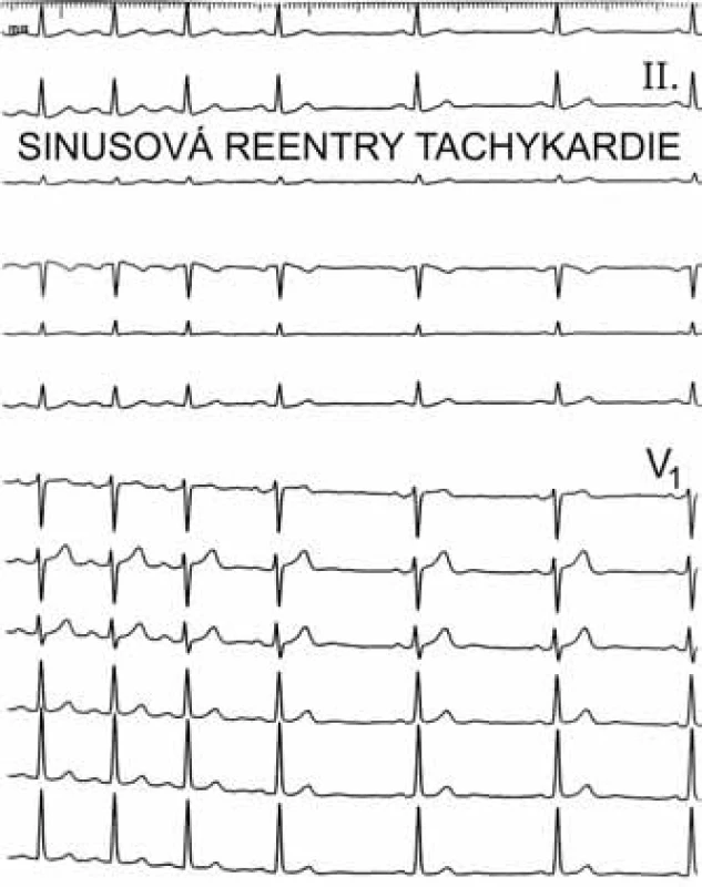 Sinusová reentry tachykardie. Morfologie P-vln v posledních 3 stazích při sinusovém rytmu je ve všech 12 svodech shodná s morfologií P-vln při tachykardii zobrazené v prvních 4 stazích, kdy tachykardie končí prakticky skokem, na rozdíl od nepřiměřené sinusové tachykardie, která by končila pozvolna.