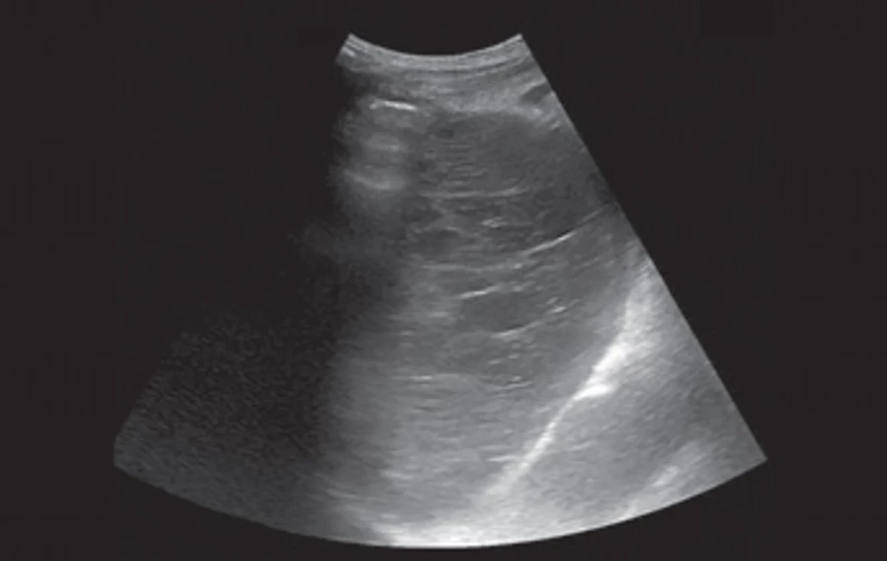 USG obraz kolekcie – heterogénna, hypoechogénna multilokulárna formácia  rozmerov  123x105 mm s anechogénnymi okrskami.   Fig. 1. Ultrasonographic view of the collection – a heterogenous, hypoechogenic multilocu lar formation 123x105  mm with anechoic areas.  