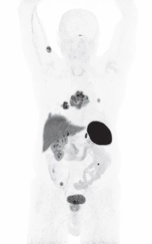68Ga-DOTATOC PET/CT 75 letého muže s generalizovaným neuroendokrinním tumorem s metastázami do plic, lymfatických uzlin, pravého plicního hilu a mediastina a do podkoží zad a pravé paže (MIP).