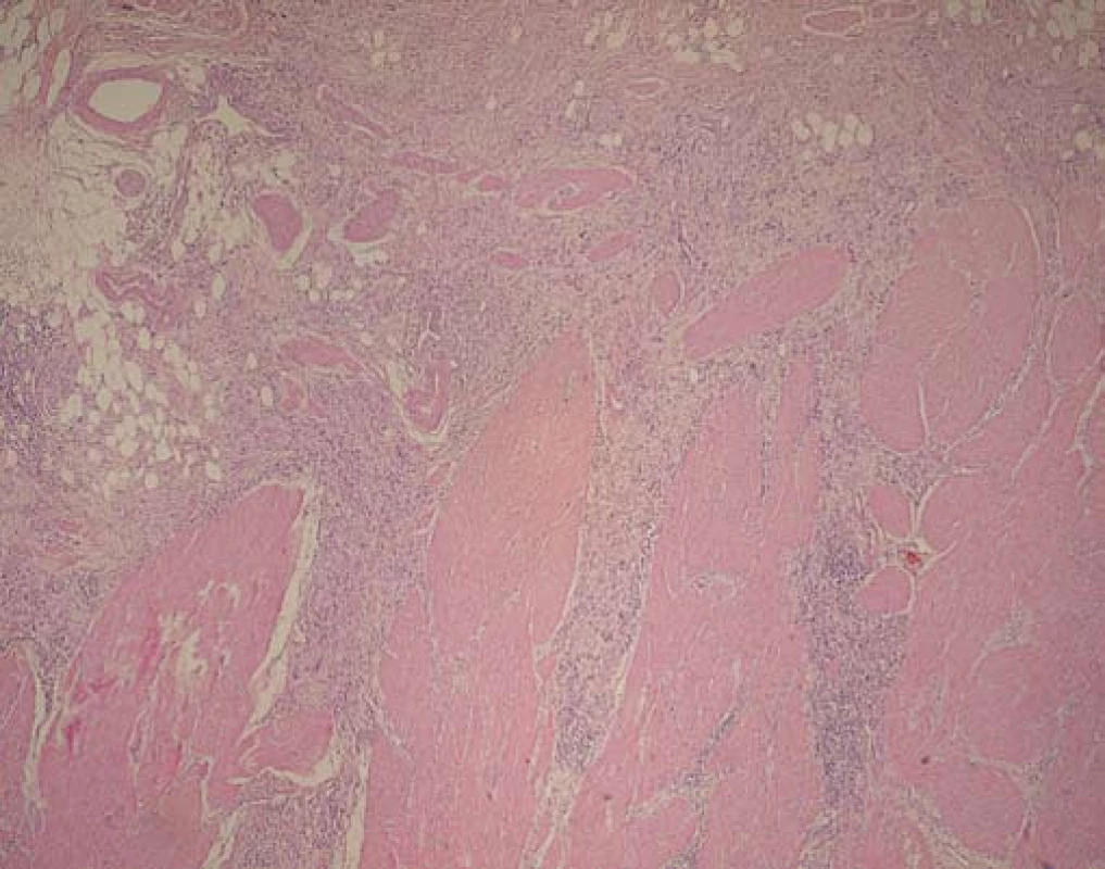 Málo diferencovaný difúzny karcinóm žalúdka (Pat. anat. odd., Onkologický ústav sv. Alžbety, Bratislava).
Fig. 2. Poorly differentiated diffuse gastric cancer (Pat. anat. odd., Cancer institute of St. Elizabeth, Bratislava).