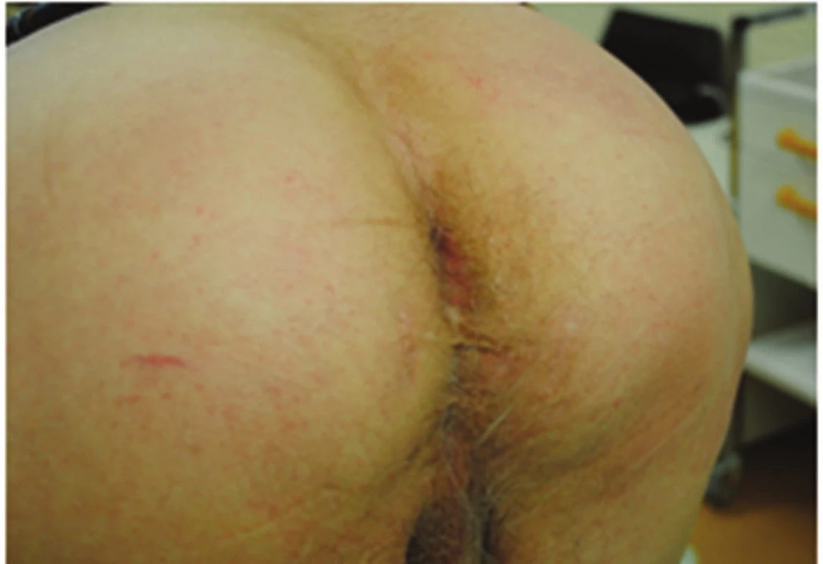 Perineum – 3 měsíce po operaci perineální kýly
Fig. 8: Perineal area – 3 months after the hernia repair