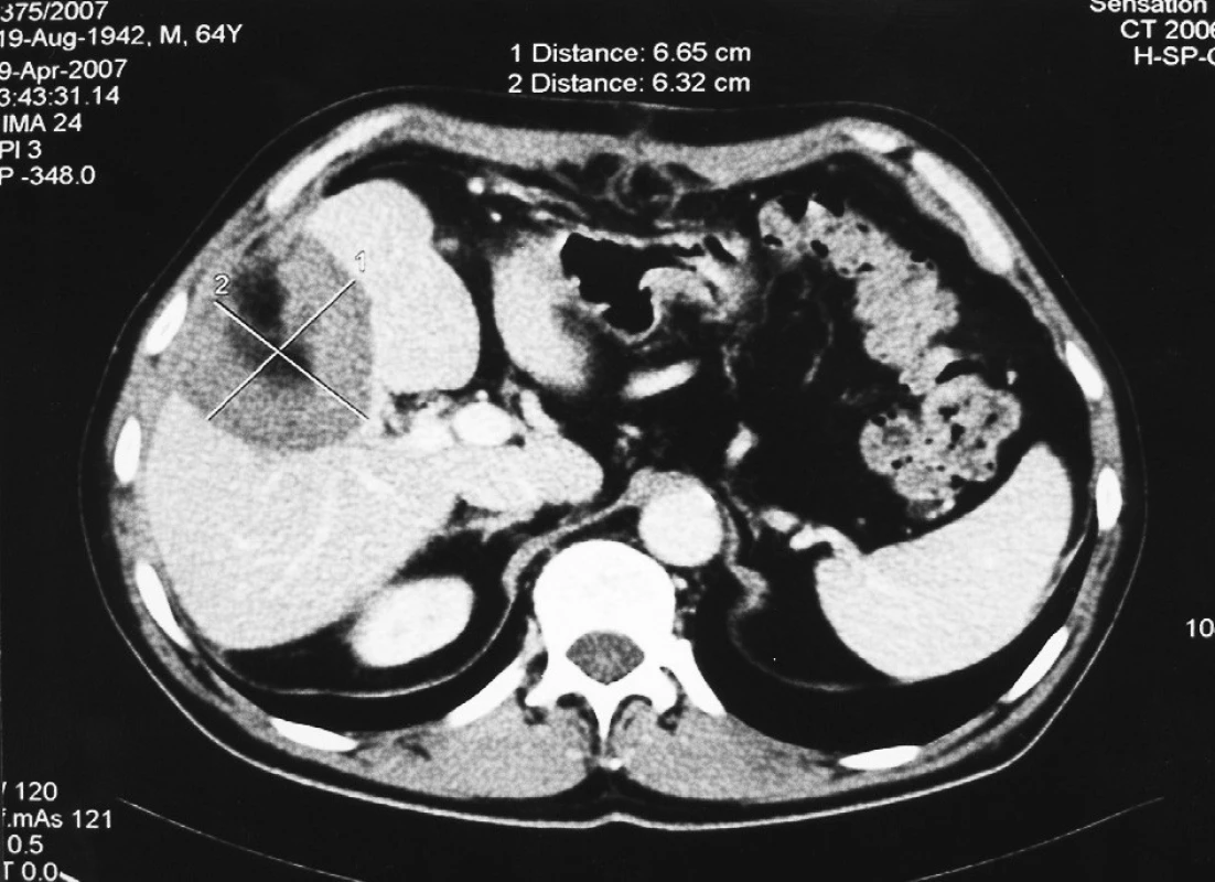 CT obraz 2 týdny po klínovité resekci metastázy v V. segmentu
Fig. 2. CT view, 2 weeks after the segment V metastasis wedge resection