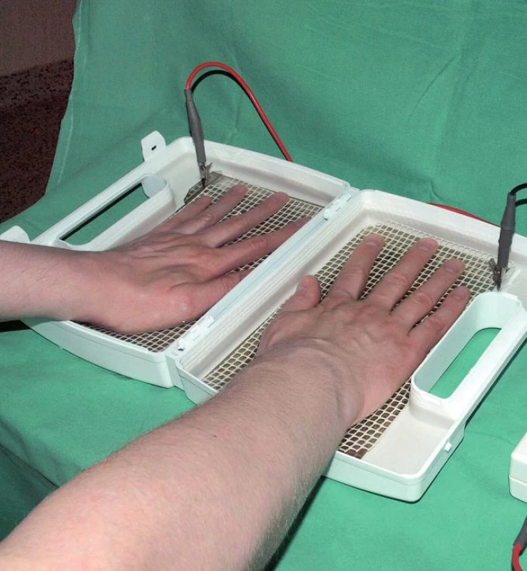 Iontoforetický přístroj v léčbě palmární fokální hyperhidrózy