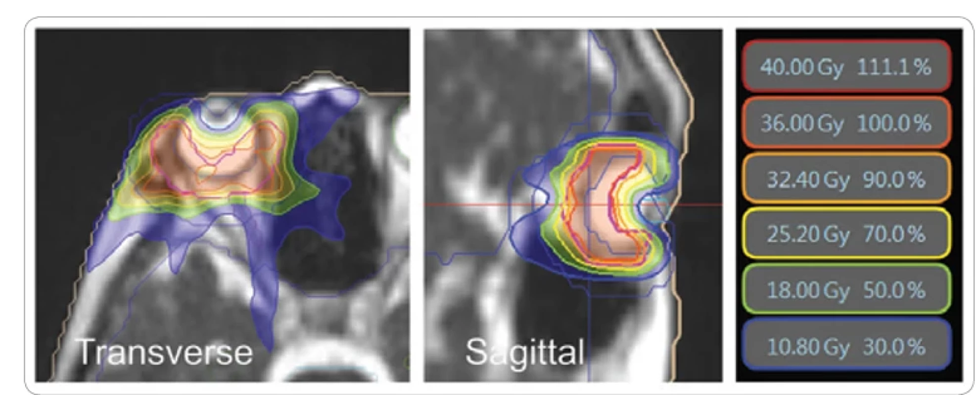 MRI-guided radiation therapy isodose lines with corresponding actual radiation dose.