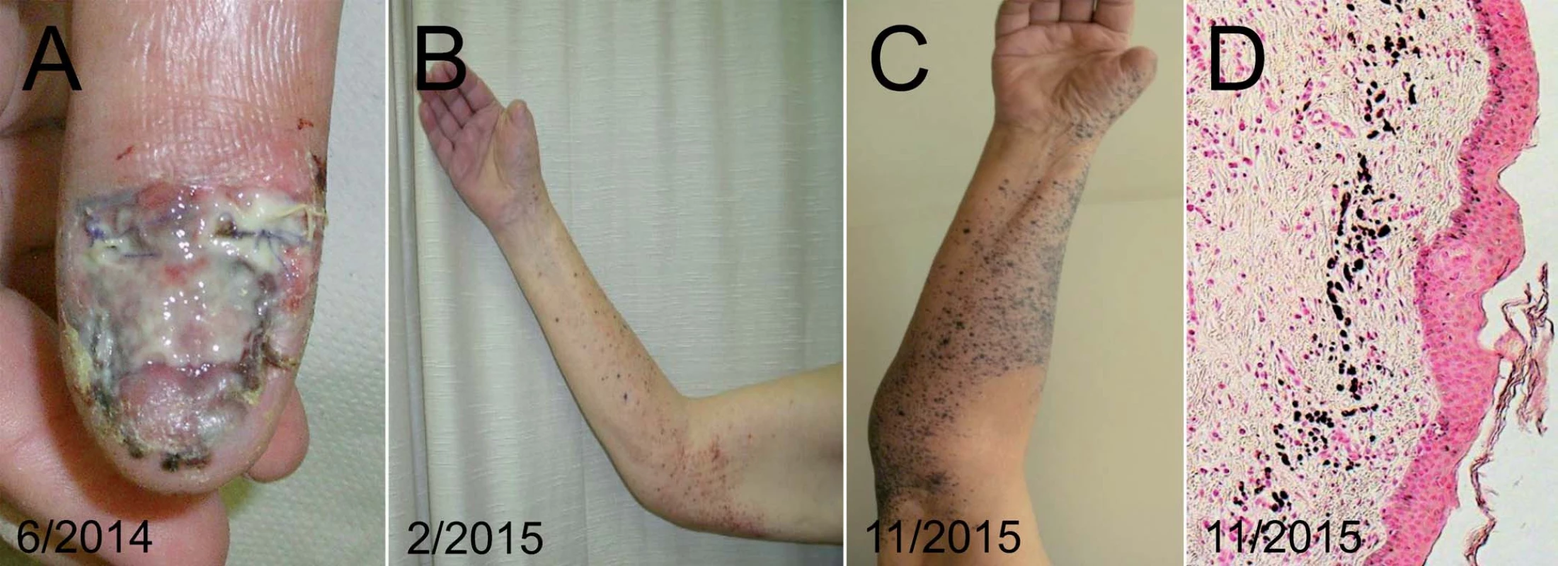Pacient, 89 let, s lokálně pokročilým melanomem palce pravé ruky.