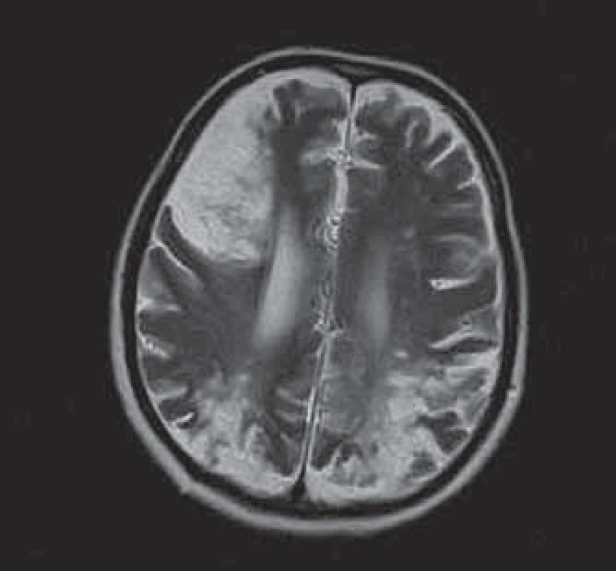 Kontrolné vyšetrenie.
MRI nález progresie rozsahu ischémií v rozličných vaskulárnych teritóriách s prechodom do chronického štádiu s tvorbou postmalatických kortiko-subkortikálnych defektov, ohraničené perifokálnou gliózou.